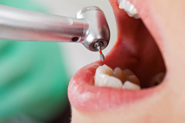Best Emergency Dental Extractions in Piedmont, SC